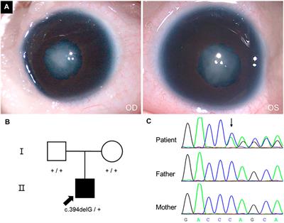 Case Report: A de novo Variant of CRYGC Gene Associated With Congenital Cataract and Microphthalmia